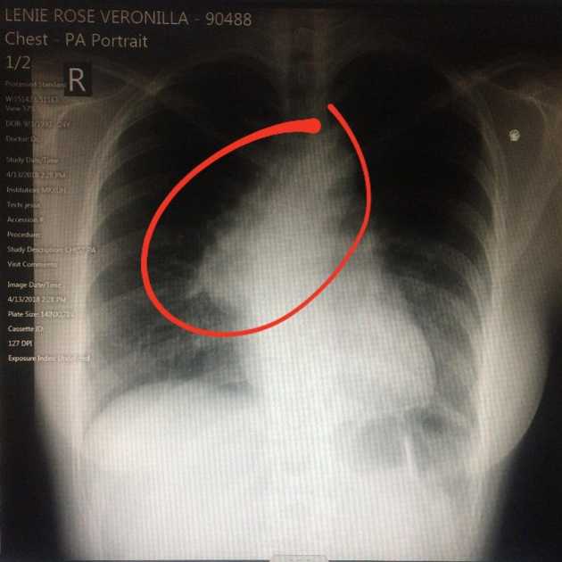 Chest X-Ray