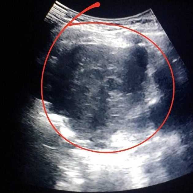 Chest Ultrasound